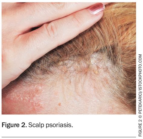 icd 10 code for sebopsoriasis scalp